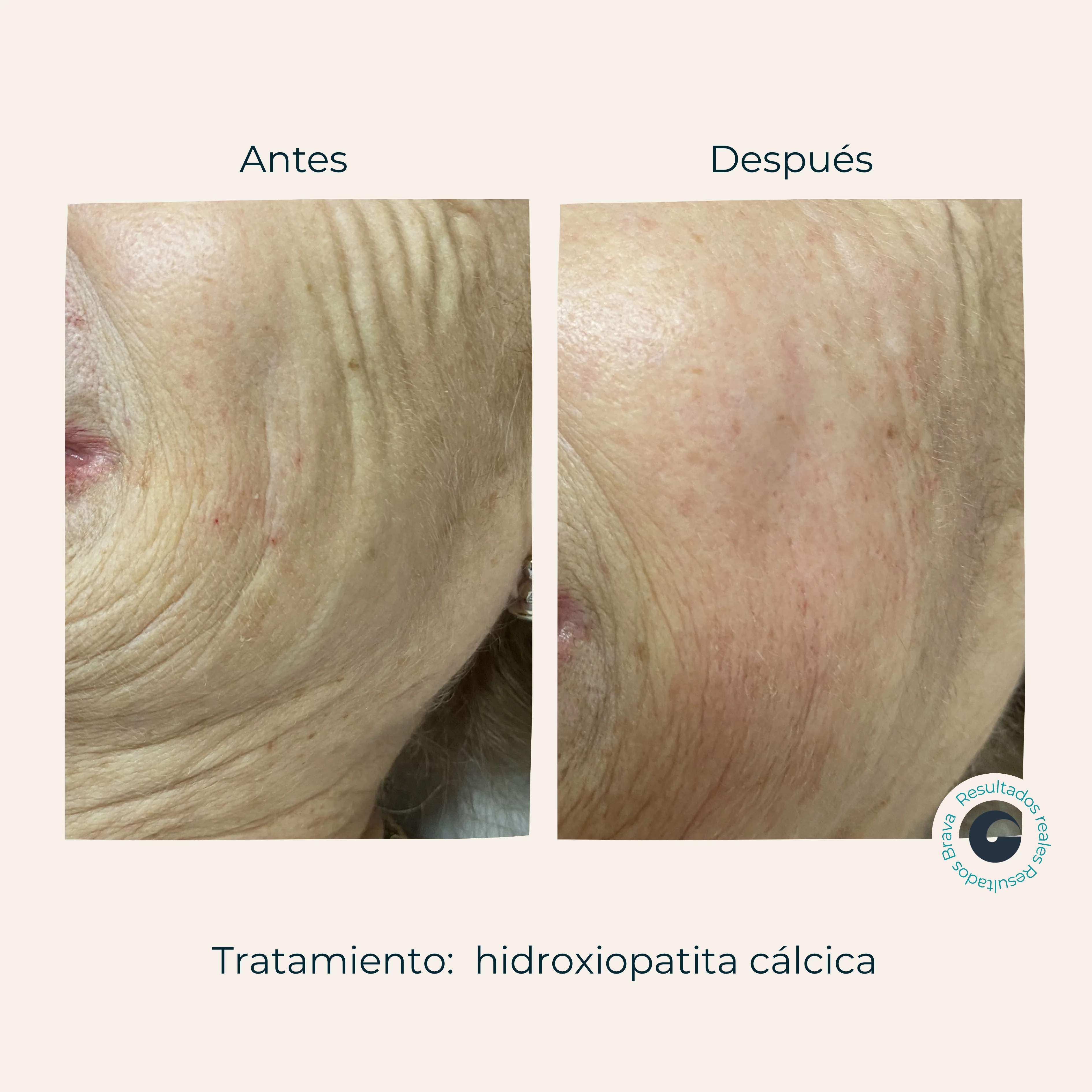 Antes y después real (12) documentado en Brava Clinic.