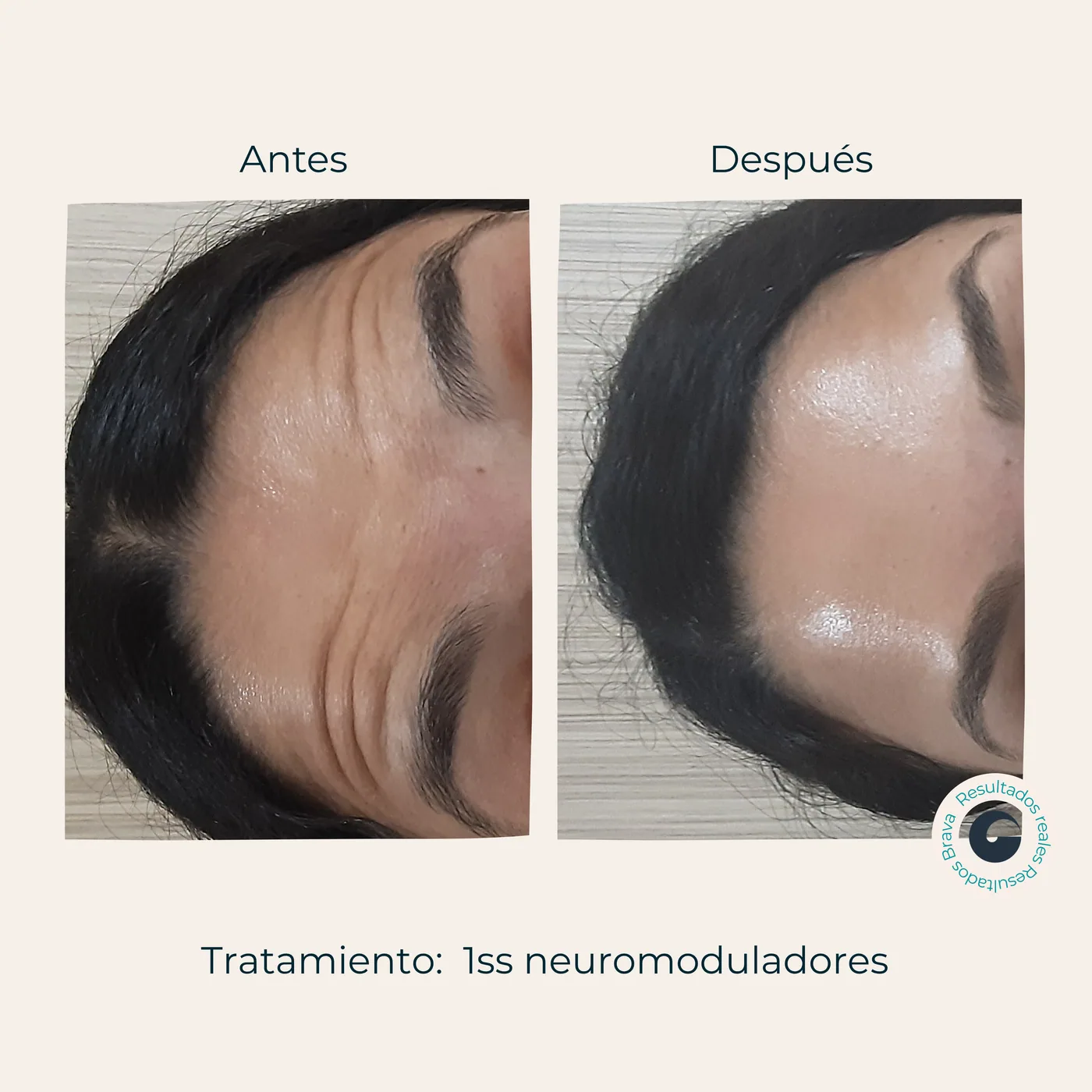 Antes y después real (16) documentado en Brava Clinic.