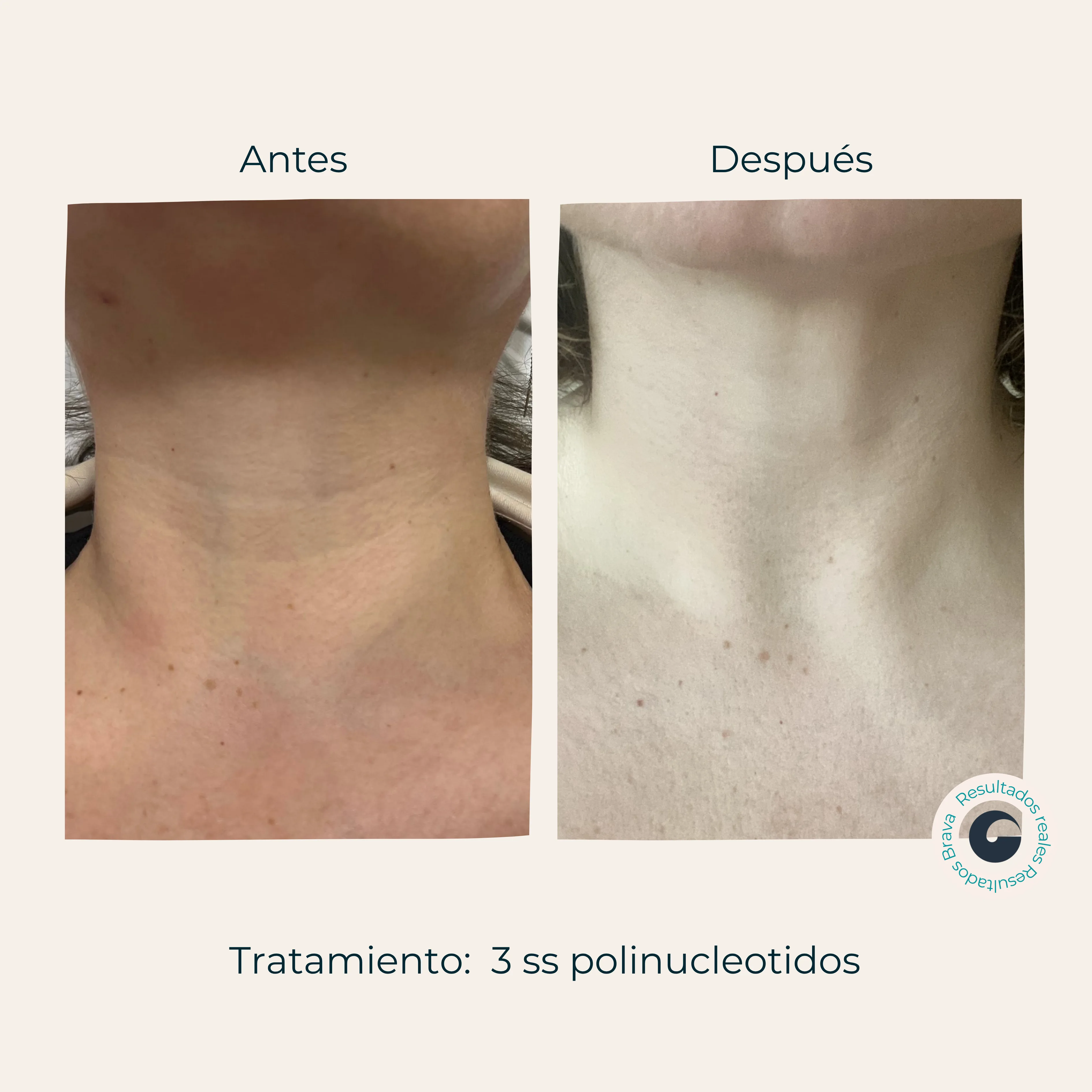 Antes y después real (2) documentado en Brava Clinic.