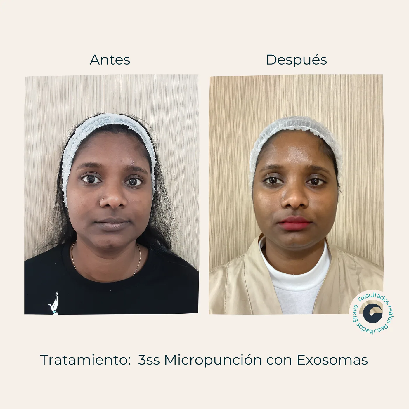 Antes y después real (20) documentado en Brava Clinic.
