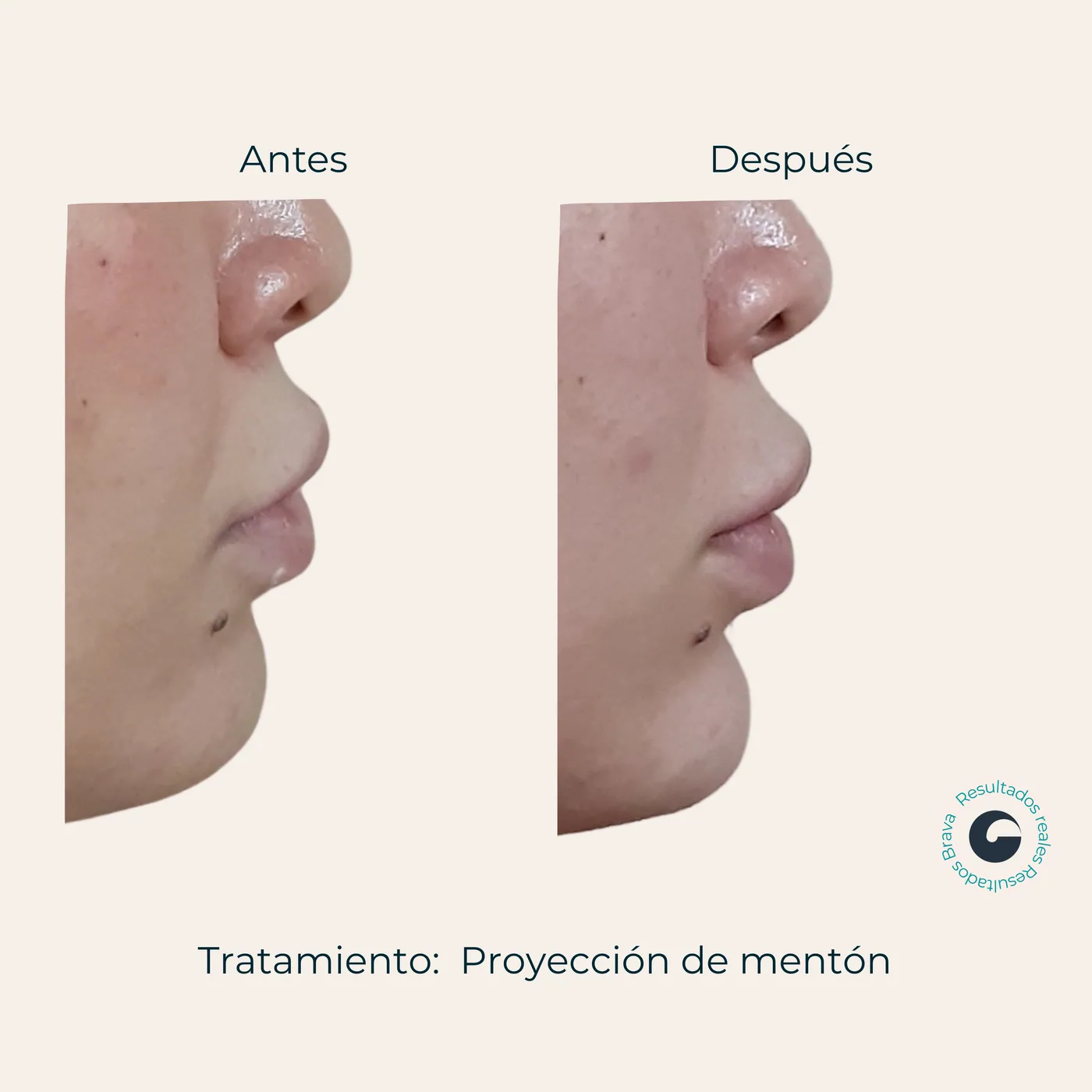Antes y después real (22) documentado en Brava Clinic.