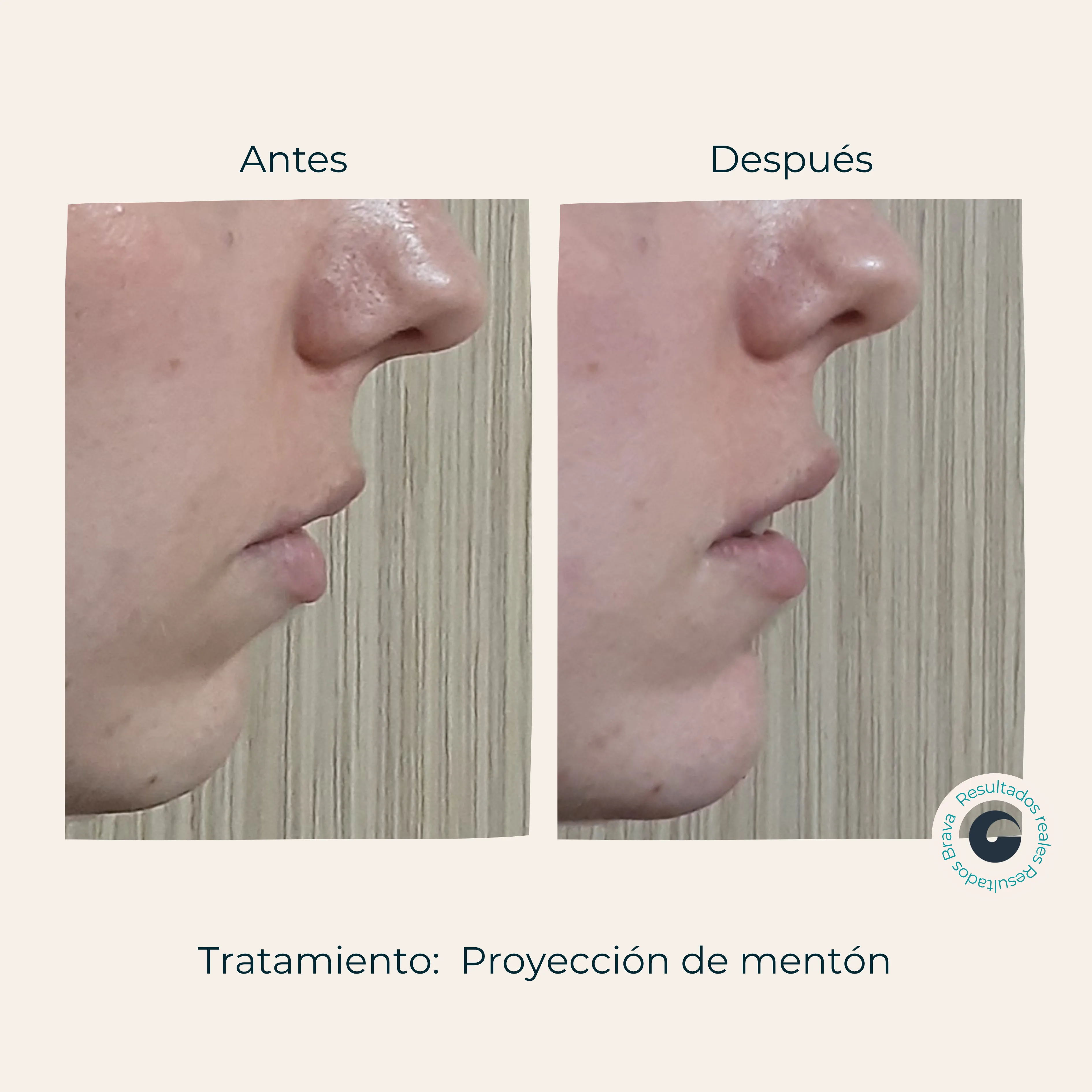 Antes y después real (23) documentado en Brava Clinic.