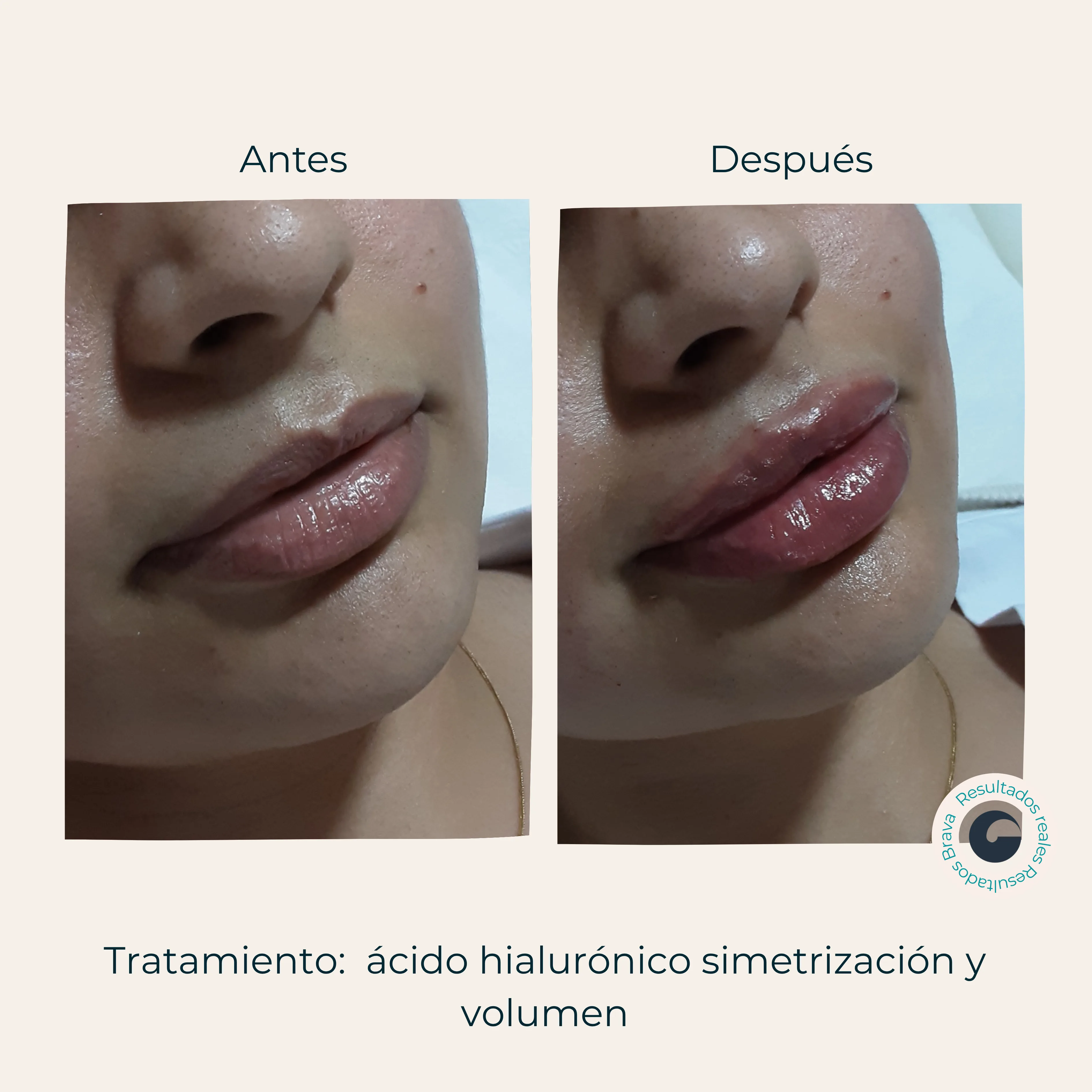Antes y después real (7) documentado en Brava Clinic.